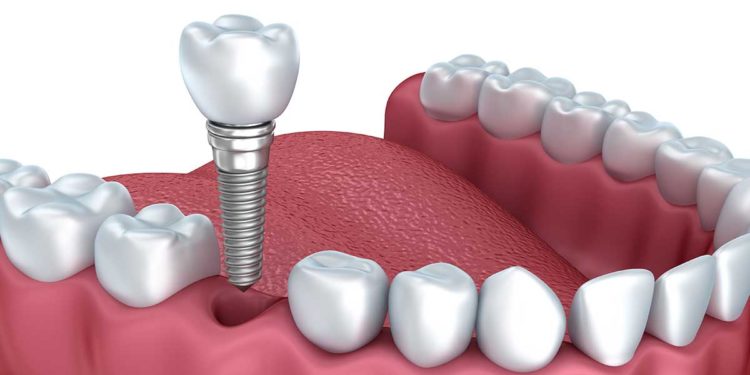 Dental Implants - Upper Marlboro, MD