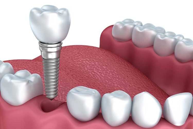 Dental Implants - Upper Marlboro, MD